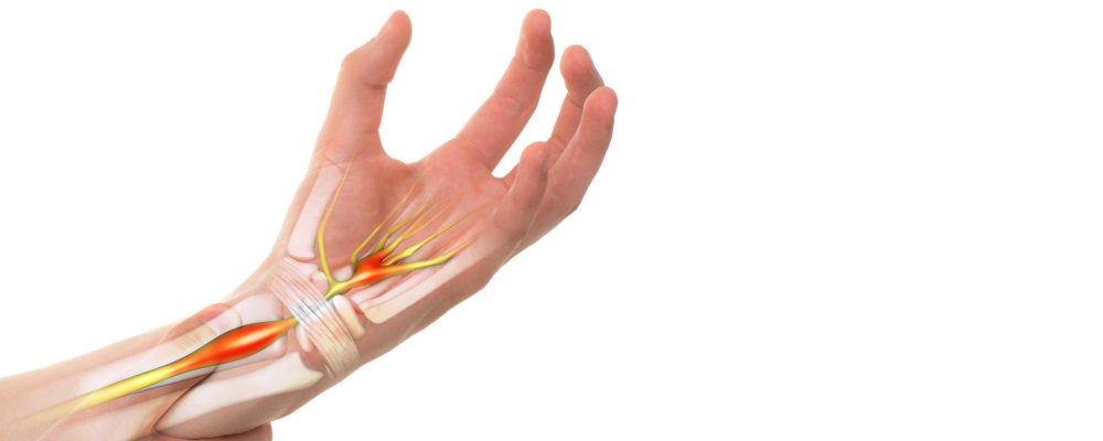 Síndroma do Túnel Cárpico